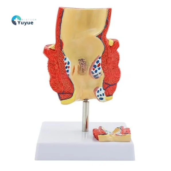 2-Part Anatomical Hemorrhoid Model for Medical Education & Pathology Demonstration Educational Equipment