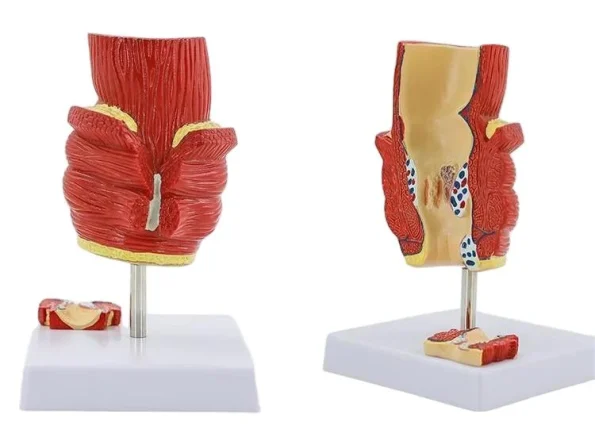 2-Part Anatomical Hemorrhoid Model for Medical Education & Pathology Demonstration Educational Equipment