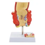 2-Part Anatomical Hemorrhoid Model for Medical Education & Pathology Demonstration Educational Equipment