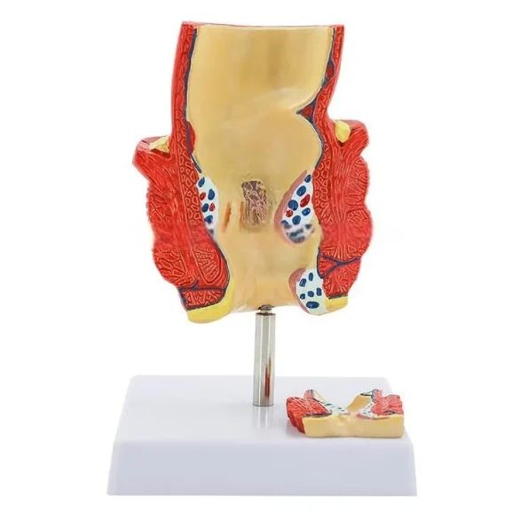 2-Part Anatomical Hemorrhoid Model for Medical Education & Pathology Demonstration Educational Equipment