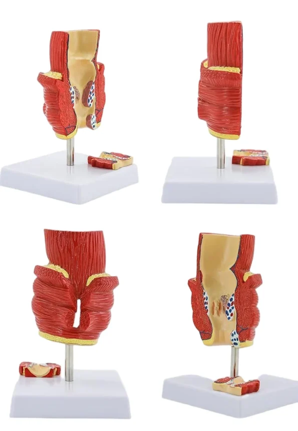 2-Part Anatomical Hemorrhoid Model for Medical Education & Pathology Demonstration Educational Equipment