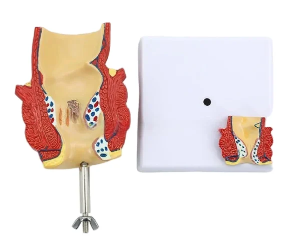 2-Part Anatomical Hemorrhoid Model for Medical Education & Pathology Demonstration Educational Equipment