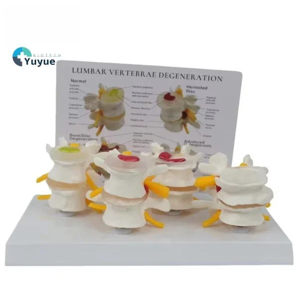 4-Stage Pathological Lumbar Spine Skeleton Model Orthopedic Training Tool with Cards for Medical Science Education