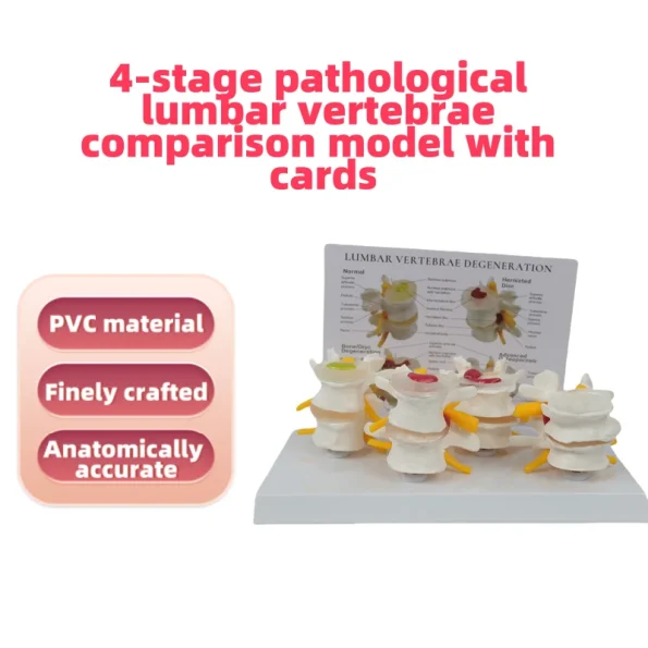 4-Stage Pathological Lumbar Spine Skeleton Model Orthopedic Training Tool with Cards for Medical Science Education