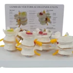 4-Stage Pathological Lumbar Spine Skeleton Model Orthopedic Training Tool with Cards for Medical Science Education