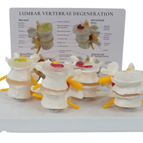 4-Stage Pathological Lumbar Spine Skeleton Model Orthopedic Training Tool with Cards for Medical Science Education