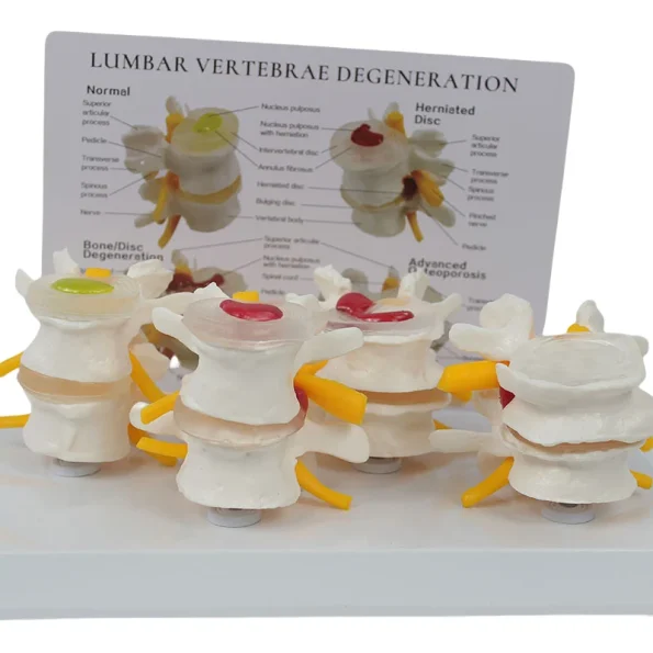 4-Stage Pathological Lumbar Spine Skeleton Model Orthopedic Training Tool with Cards for Medical Science Education