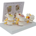 4-Stage Pathological Lumbar Spine Skeleton Model Orthopedic Training Tool with Cards for Medical Science Education