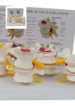 4-Stage Pathological Lumbar Spine Skeleton Model Orthopedic Training Tool with Cards for Medical Science Education