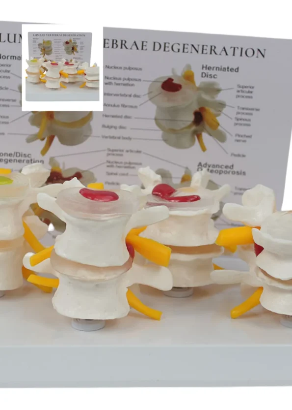 4-Stage Pathological Lumbar Spine Skeleton Model Orthopedic Training Tool with Cards for Medical Science Education