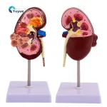 Anatomical PVC Kidney Model for Medical School Teaching Simulating Diseased Kidney and Urinary System