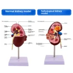 Anatomical PVC Kidney Model for Medical School Teaching Simulating Diseased Kidney and Urinary System