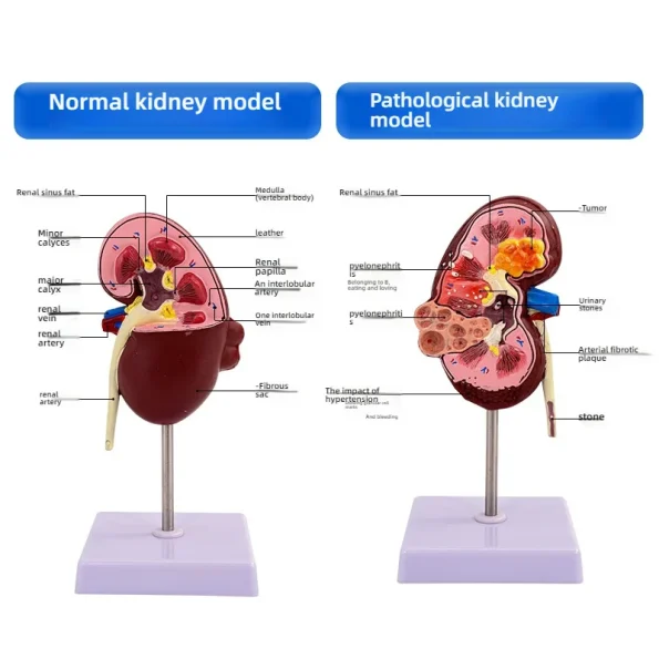 Anatomical PVC Kidney Model for Medical School Teaching Simulating Diseased Kidney and Urinary System