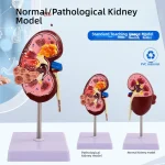 Anatomical PVC Kidney Model for Medical School Teaching Simulating Diseased Kidney and Urinary System
