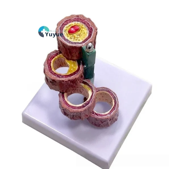 Anatomical PVC Model for Medical Science Four Stages of Artery Atherosclerosis and Thrombosis Training Model