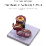 Anatomical PVC Model for Medical Science Four Stages of Artery Atherosclerosis and Thrombosis Training Model
