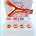 Anatomical PVC Model for Medical Science Four Stages of Artery Atherosclerosis and Thrombosis Training Model