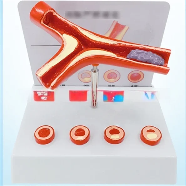 Anatomical PVC Model for Medical Science Four Stages of Artery Atherosclerosis and Thrombosis Training Model