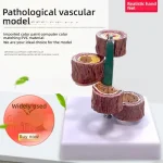 Anatomical PVC Model for Medical Science Four Stages of Artery Atherosclerosis and Thrombosis Training Model