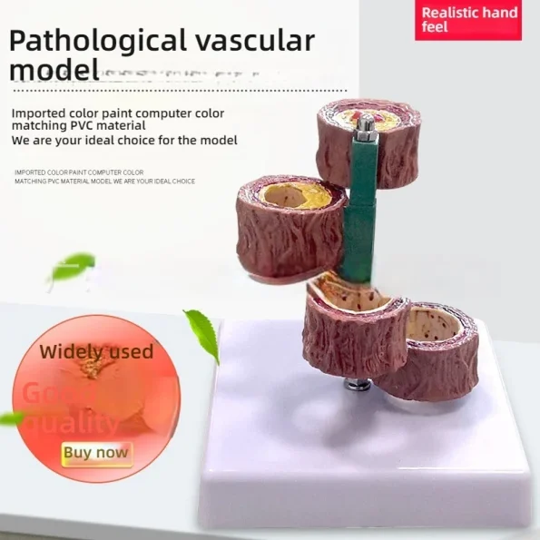 Anatomical PVC Model for Medical Science Four Stages of Artery Atherosclerosis and Thrombosis Training Model