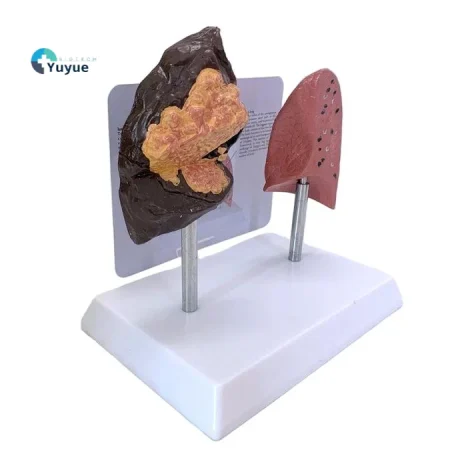Comparative Model for Smoker's Lung Vs Normal Lung Educational Equipment