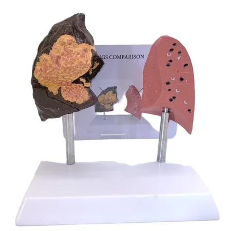 Comparative Model for Smoker's Lung Vs Normal Lung Educational Equipment