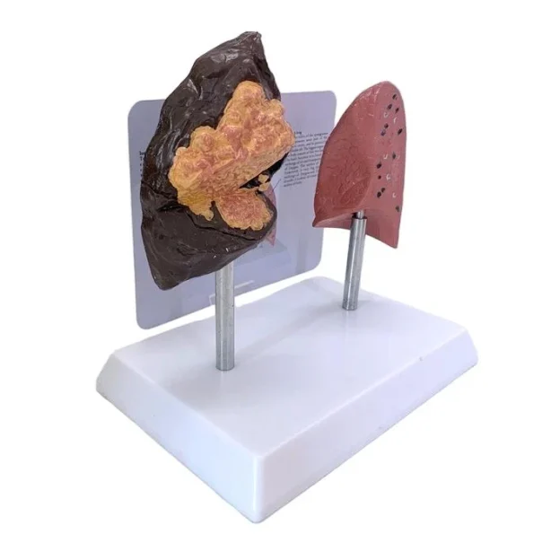 Comparative Model for Smoker's Lung Vs Normal Lung Educational Equipment