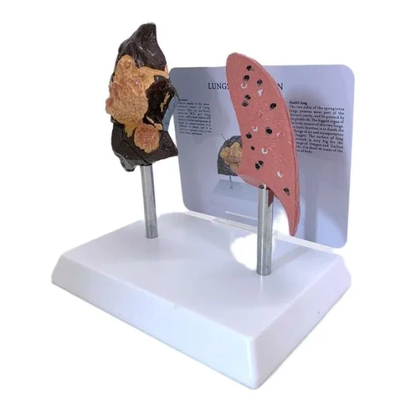 Comparative Model for Smoker's Lung Vs Normal Lung Educational Equipment