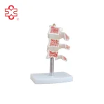 Cutaway Osteoporosis Anatomical Model PVC Material ISO Certified Xincheng Brand Model XC-134