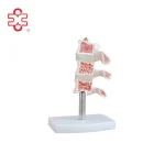 Cutaway Osteoporosis Anatomical Model PVC Material ISO Certified Xincheng Brand Model XC-134