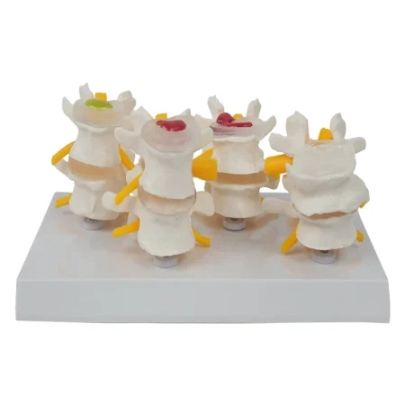 Four - Stage Lumbar Spine Lesion Anatomical Model for Medical Education