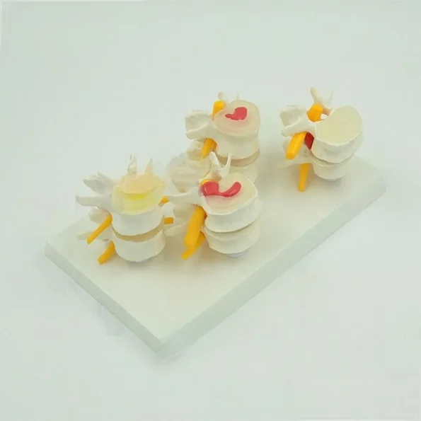 Four - Stage Lumbar Spine Lesion Anatomical Model for Medical Education