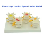 Four - Stage Lumbar Spine Lesion Anatomical Model for Medical Education