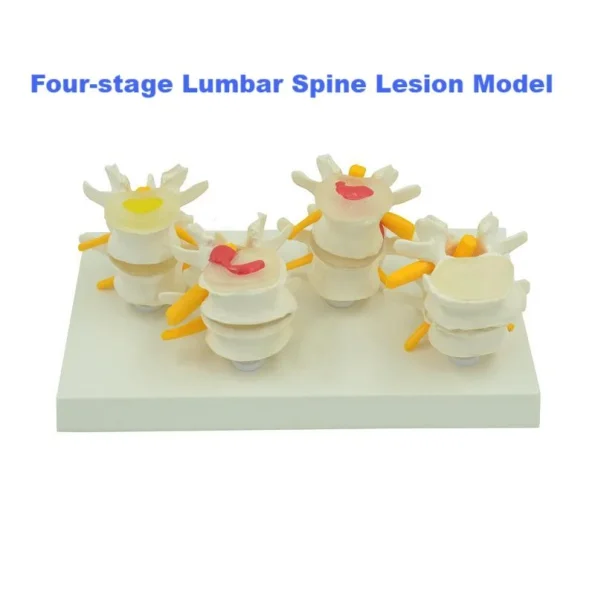 Four - Stage Lumbar Spine Lesion Anatomical Model for Medical Education