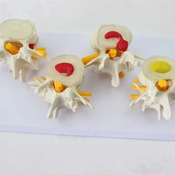Four - Stage Lumbar Spine Lesion Anatomical Model for Medical Education
