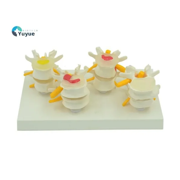 Four - Stage Lumbar Spine Lesion Anatomical Model for Medical Education