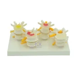 Four - Stage Lumbar Spine Lesion Anatomical Model for Medical Education
