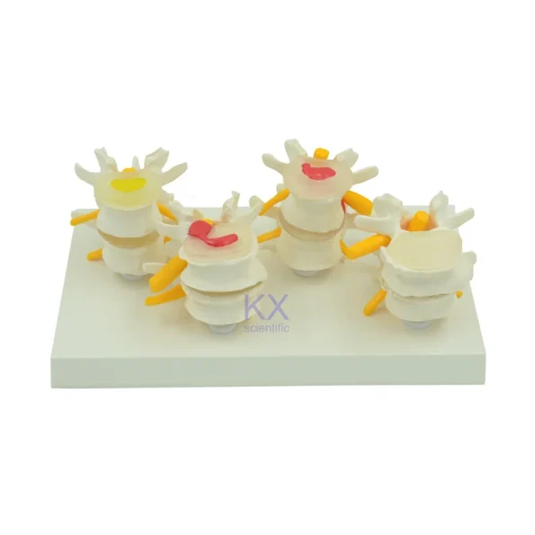 Four - Stage Lumbar Spine Lesion Anatomical Model for Medical Education
