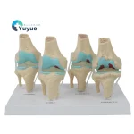 Four-Stage Pathological Shoulder Joint Model Muscle Origins Insertions Osteoarthritis Cartilage Damage Demonstration Medical