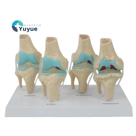 Four-Stage Pathological Shoulder Joint Model Muscle Origins Insertions Osteoarthritis Cartilage Damage Demonstration Medical