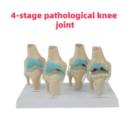 Four-Stage Pathological Shoulder Joint Model Muscle Origins Insertions Osteoarthritis Cartilage Damage Demonstration Medical