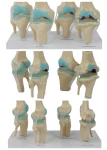Four-Stage Pathological Shoulder Joint Model Muscle Origins Insertions Osteoarthritis Cartilage Damage Demonstration Medical