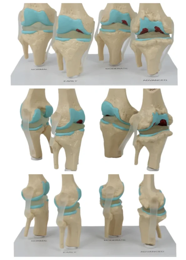 Four-Stage Pathological Shoulder Joint Model Muscle Origins Insertions Osteoarthritis Cartilage Damage Demonstration Medical