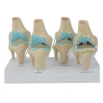 Four-Stage Pathological Shoulder Joint Model Muscle Origins Insertions Osteoarthritis Cartilage Damage Demonstration Medical
