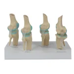 Four-Stage Pathological Shoulder Joint Model Muscle Origins Insertions Osteoarthritis Cartilage Damage Demonstration Medical