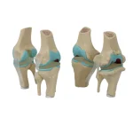 Four-Stage Pathological Shoulder Joint Model Muscle Origins Insertions Osteoarthritis Cartilage Damage Demonstration Medical