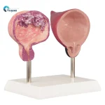 Human Bladder Model Set Normal Vs Smoking-Induced Changes for Educational Purposes