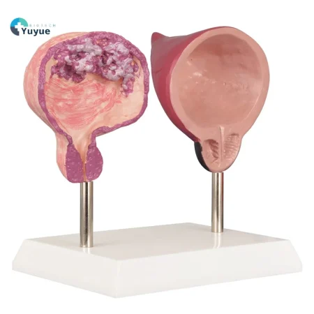 Human Bladder Model Set Normal Vs Smoking-Induced Changes for Educational Purposes