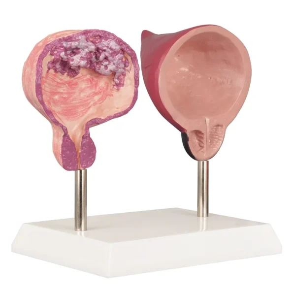 Human Bladder Model Set Normal Vs Smoking-Induced Changes for Educational Purposes