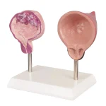 Human Bladder Model Set Normal Vs Smoking-Induced Changes for Educational Purposes